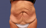 Abdominoplasty (Tummy Tuck) 26 Before